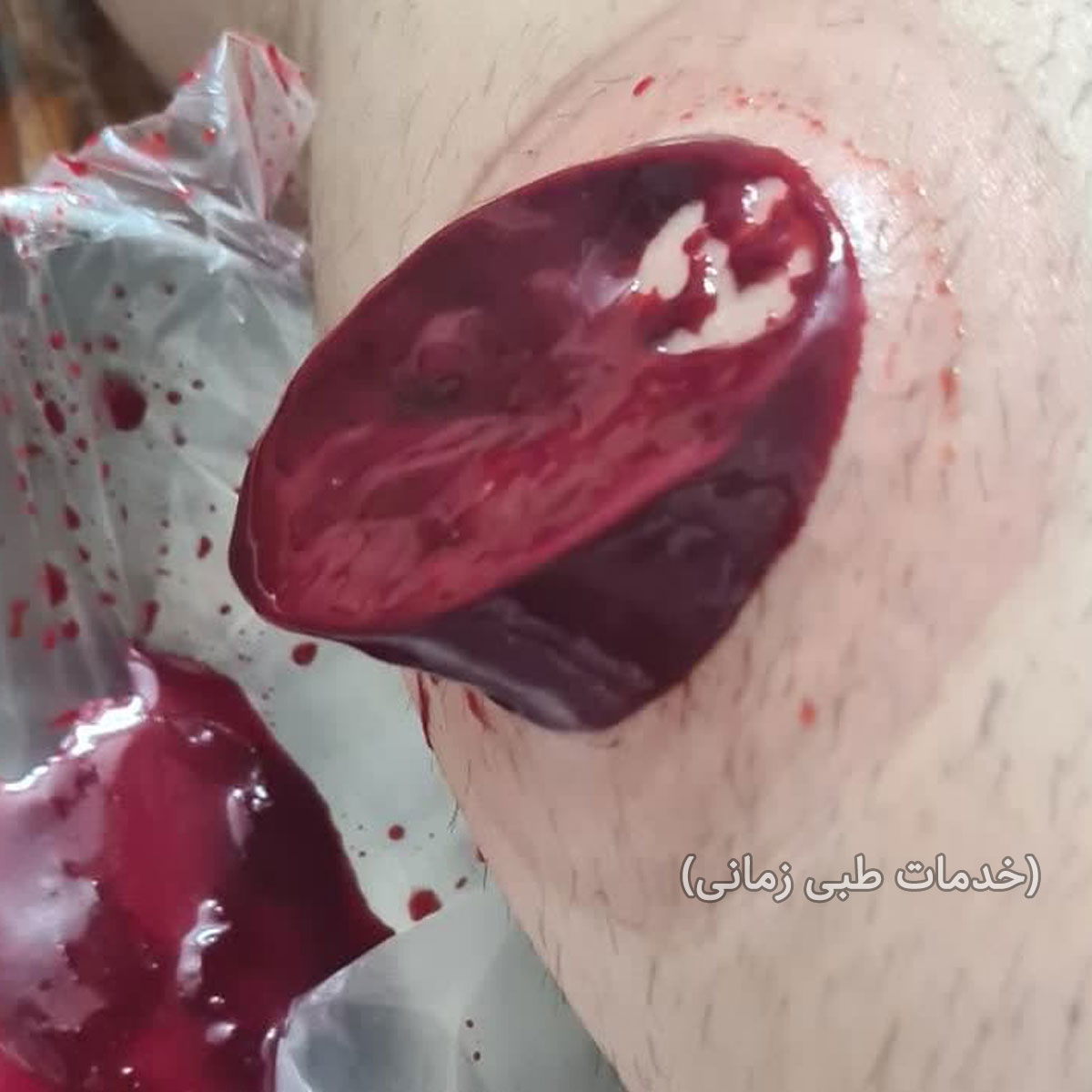 حجامت ساق پا